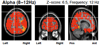 alphs wave brain scan before neurofeedback therapy